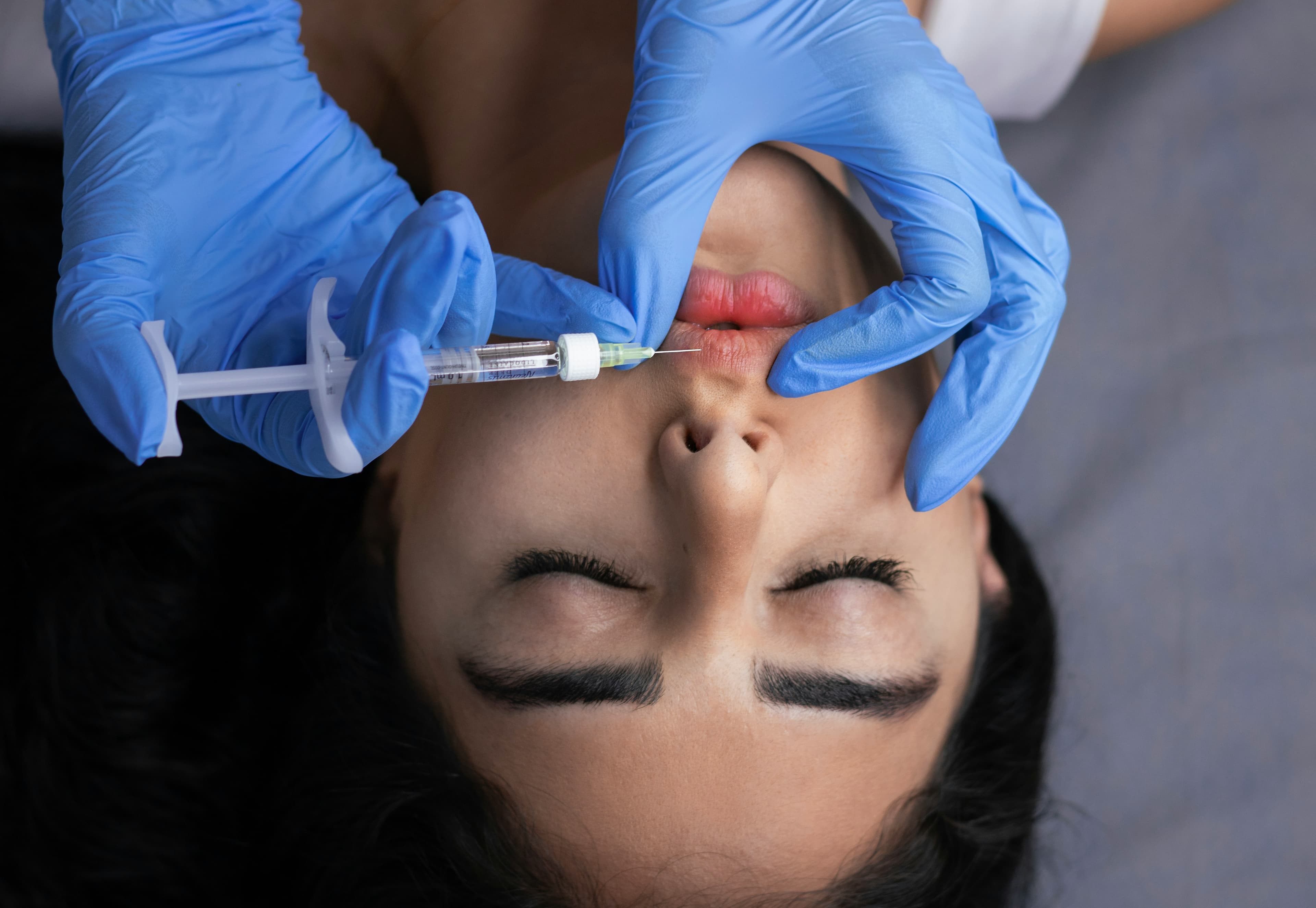 Dermal Fillers treatment at Milan Medical