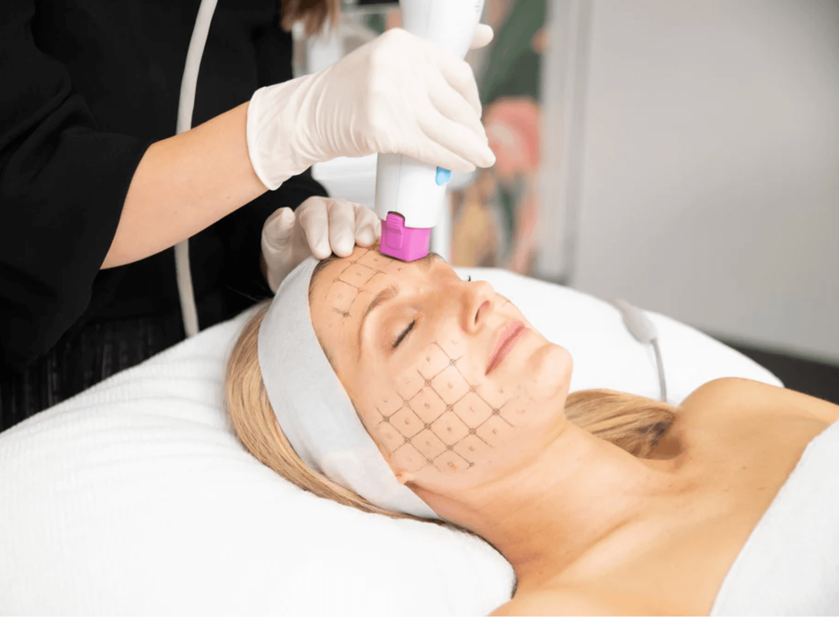 Thermage & Ultherapy treatment at Milan Medical